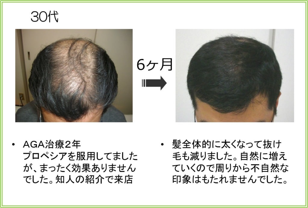 30代男性の発毛実績（6ヶ月）