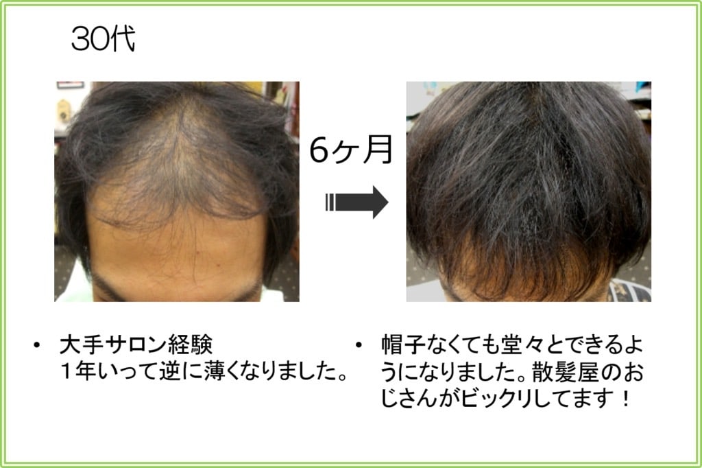 30代男性の発毛実績（6ヶ月）