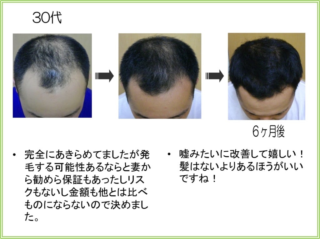 30代男性の発毛実績（6ヶ月）