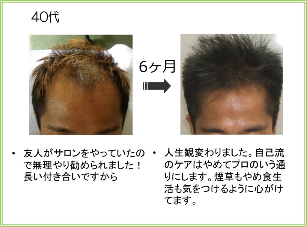 40代男性の発毛実績（6ヶ月）