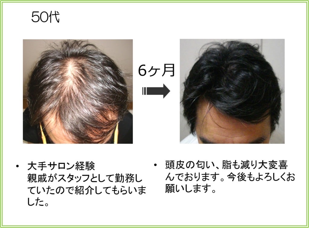 50代男性の発毛実績（6ヶ月）