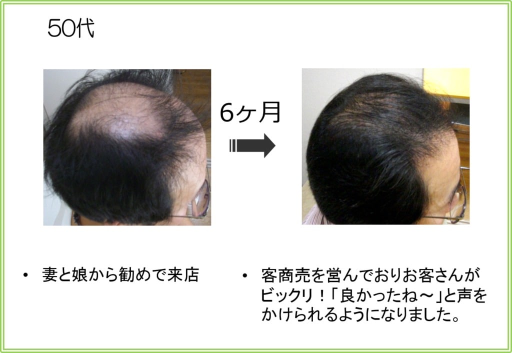 50代男性の発毛実績（6ヶ月）
