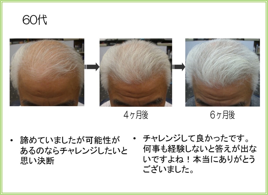60代男性の発毛実績（6ヶ月）