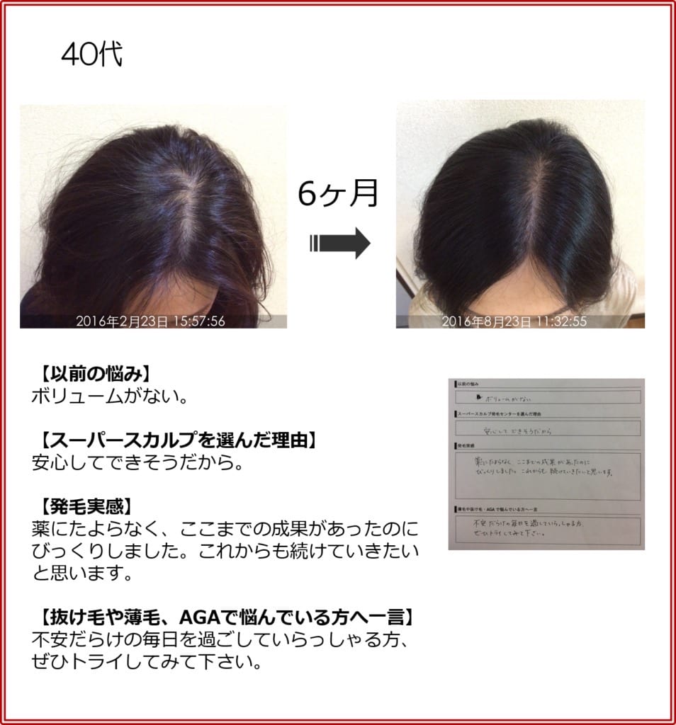 40代女性の発毛実績（6ヶ月）