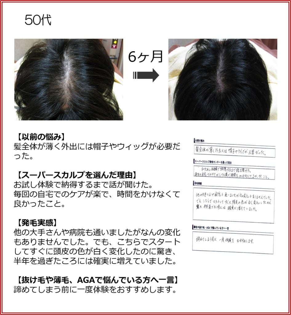 50代女性の発毛実績（6ヶ月）