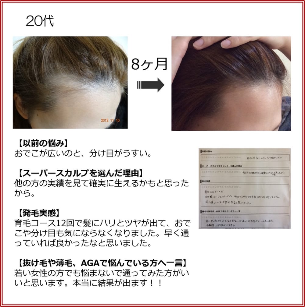 20代女性の発毛実績（8ヶ月）