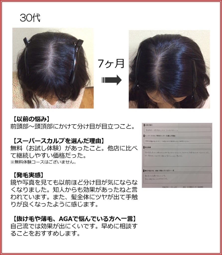 30代女性の発毛実績（7ヶ月）