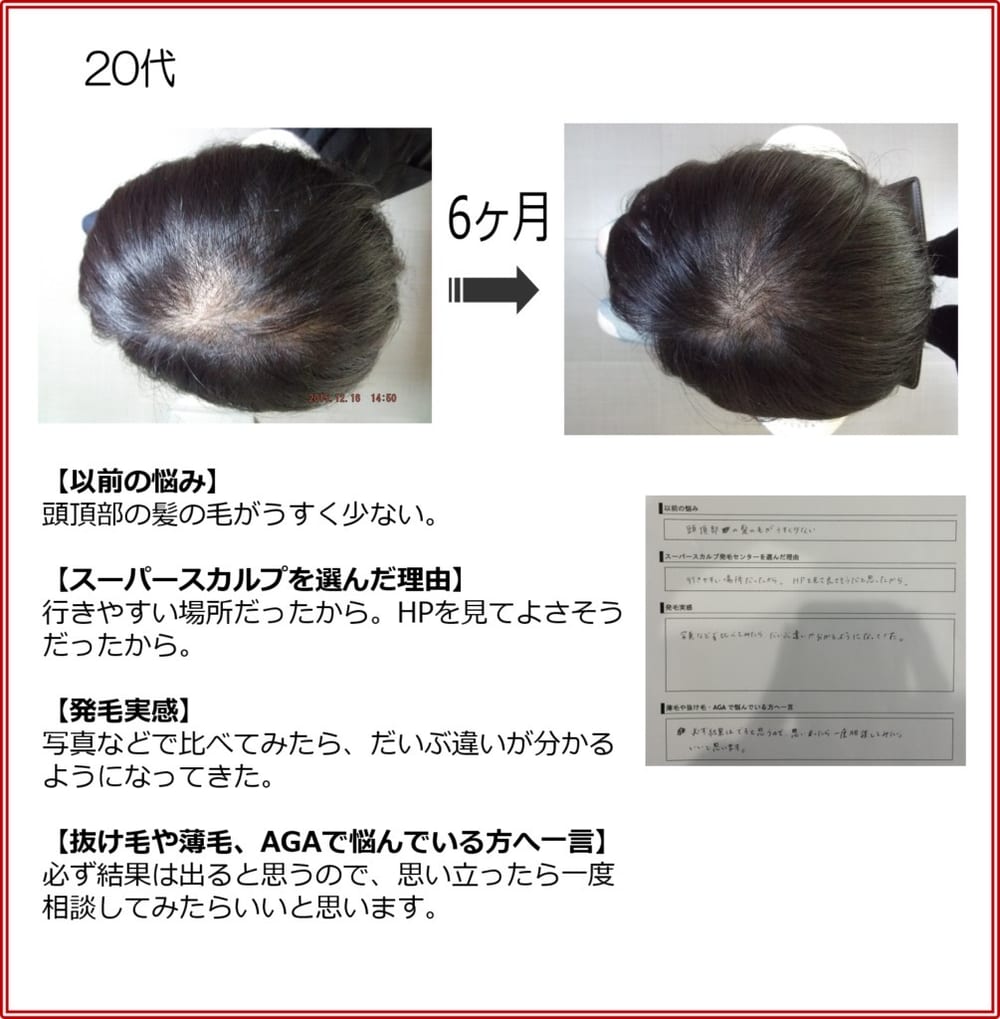 20代女性の発毛実績（6ヶ月）