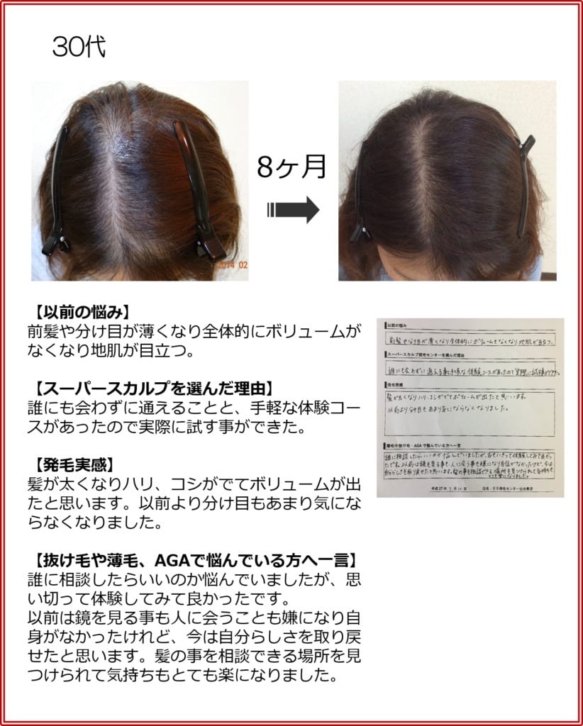 30代女性の発毛実績（8ヶ月）
