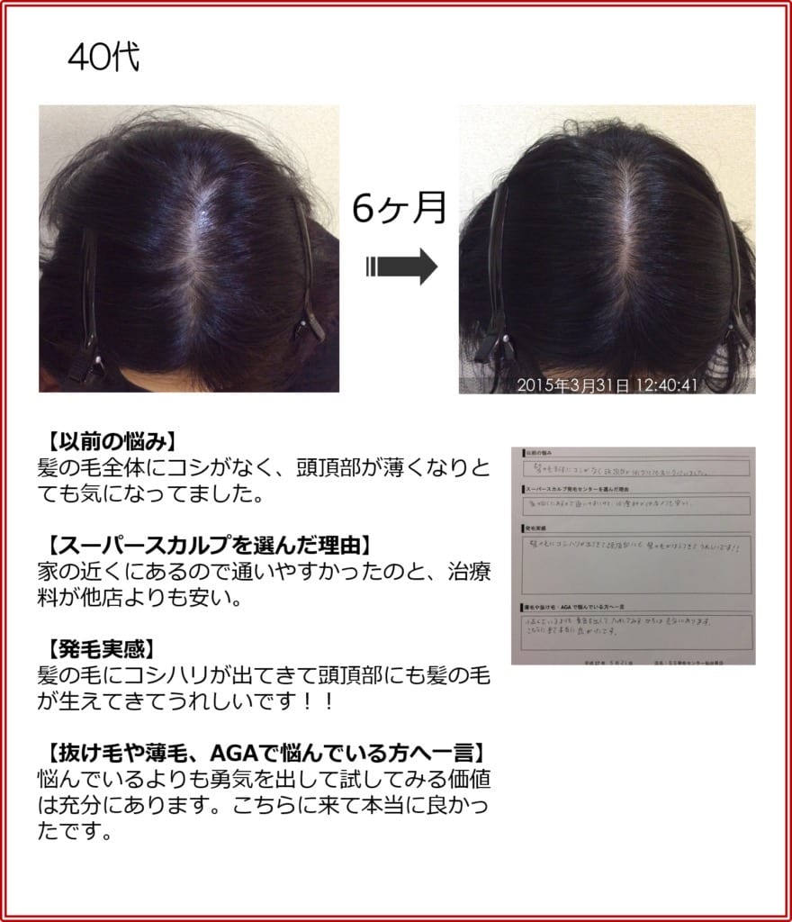 40代女性の発毛実績（6ヶ月）