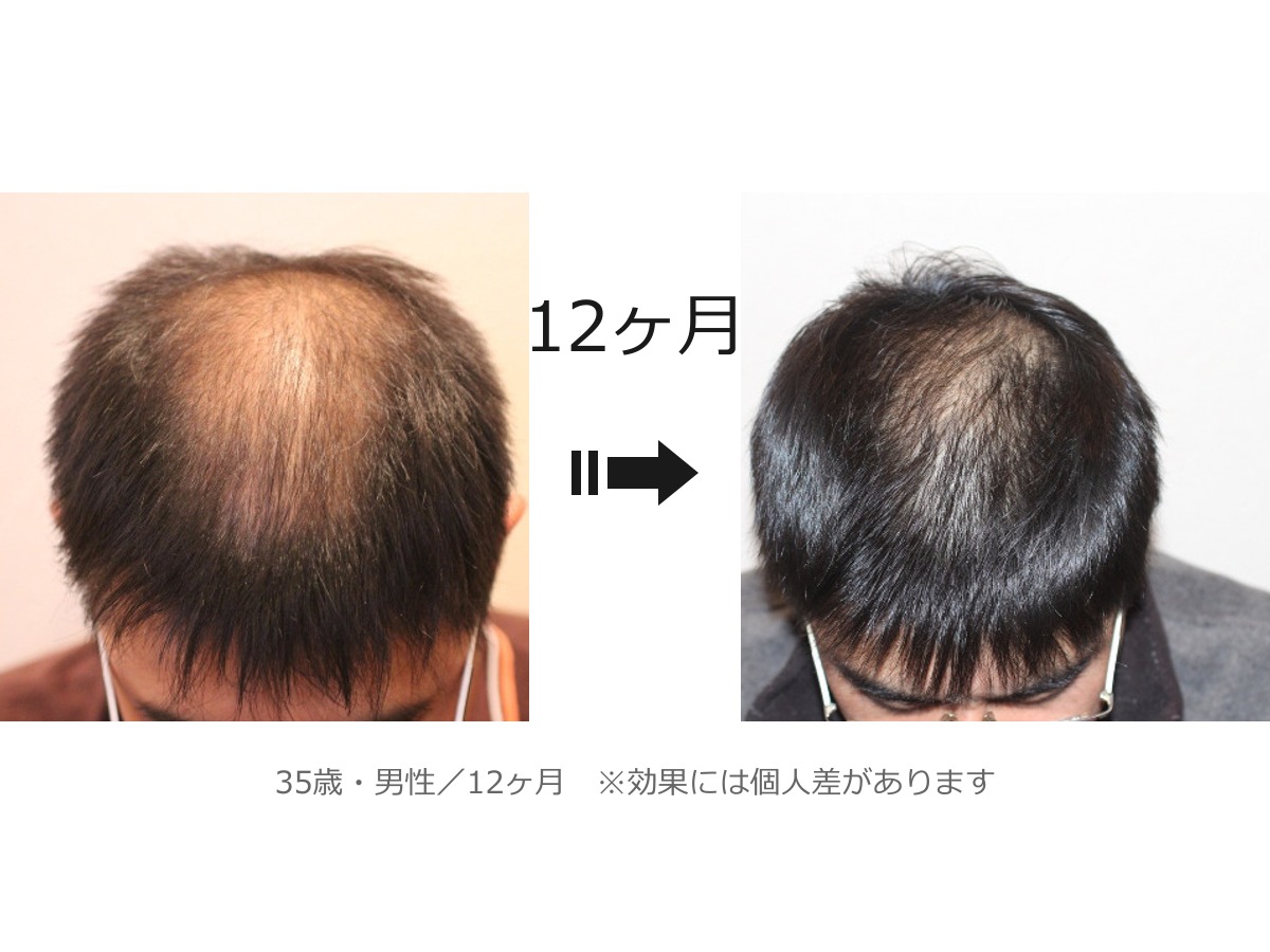 施術12ヶ月後の頭皮の変化（35歳男性）※効果には個人差があります